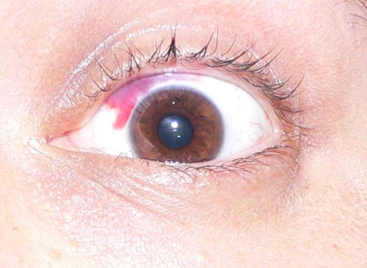 my father had laser eye 2011